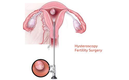 Hysteroscopy Fertility Surgery