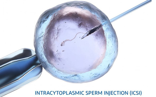 Intracytoplasmic sperm injection (ICSI)